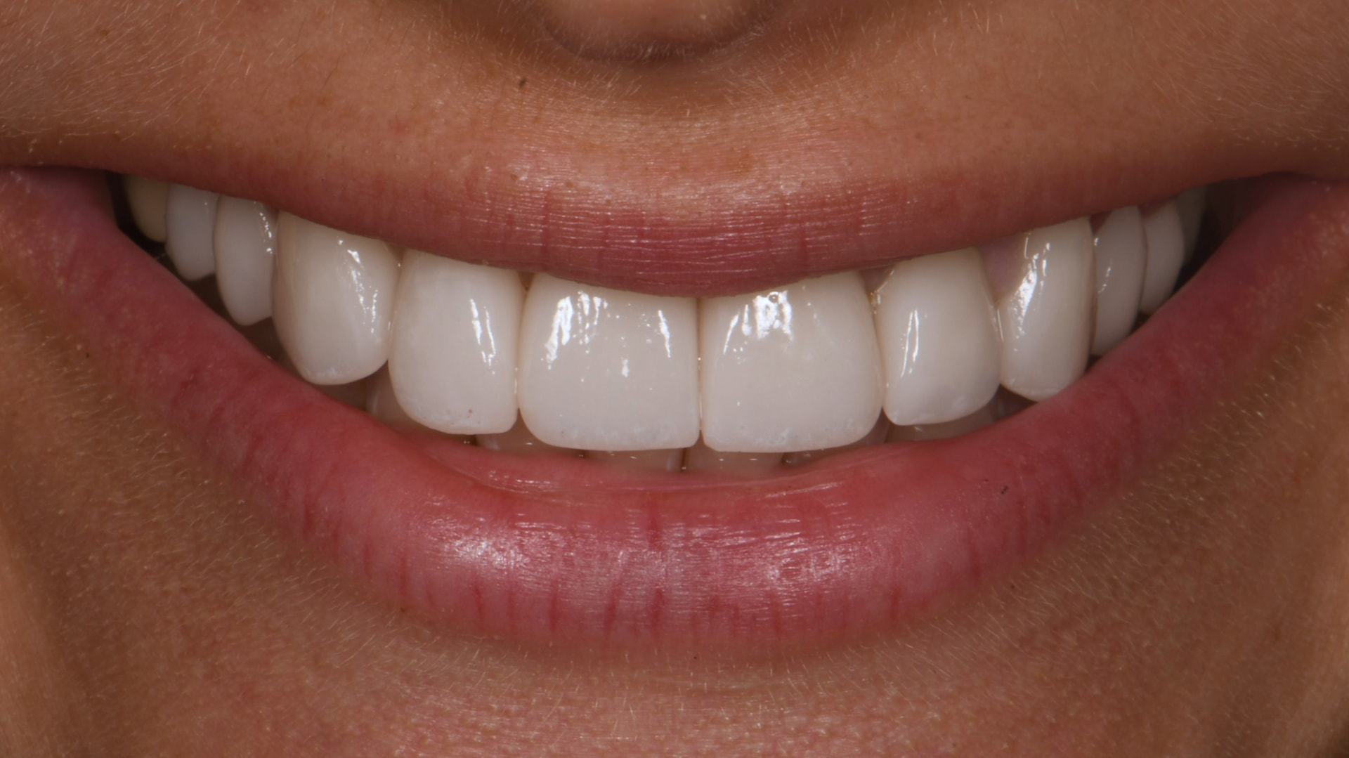 Full Smile Makeover | Veneers — after