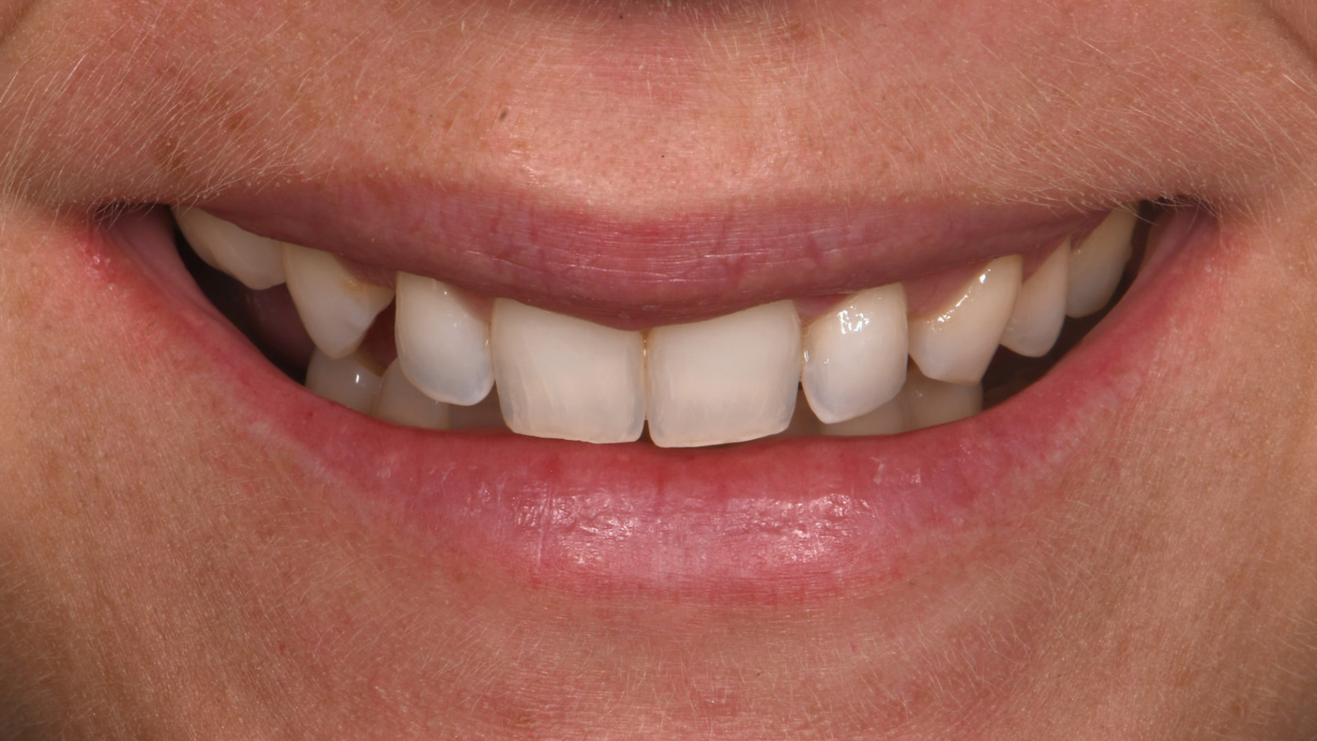 Smile Makeover | Veneers — before
