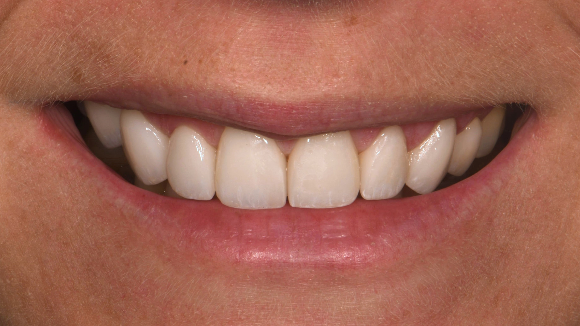 Smile Makeover | Veneers — after