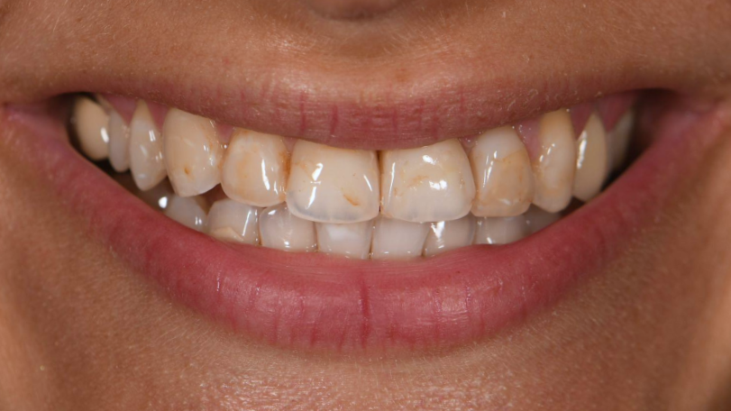 Full Smile Makeover | Veneers — before
